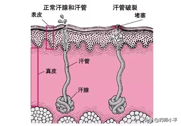 一张图教你区别湿疹和痱子