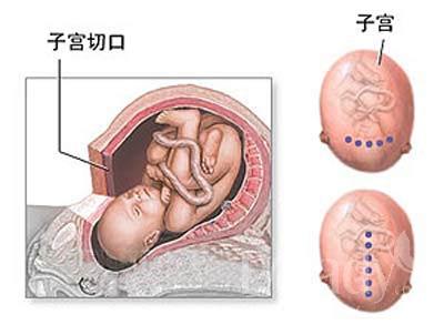 剖腹产