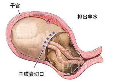 剖腹产