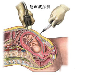 下面是胎儿脐带血取样图文介绍