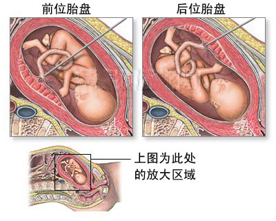 下面是胎儿脐带血取样图文介绍