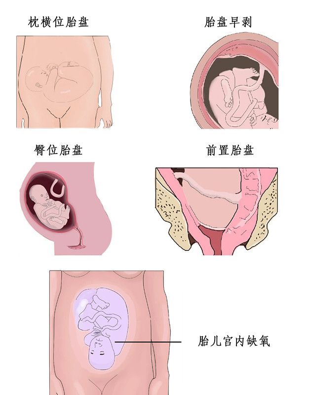 剖腹产分娩全过程图片