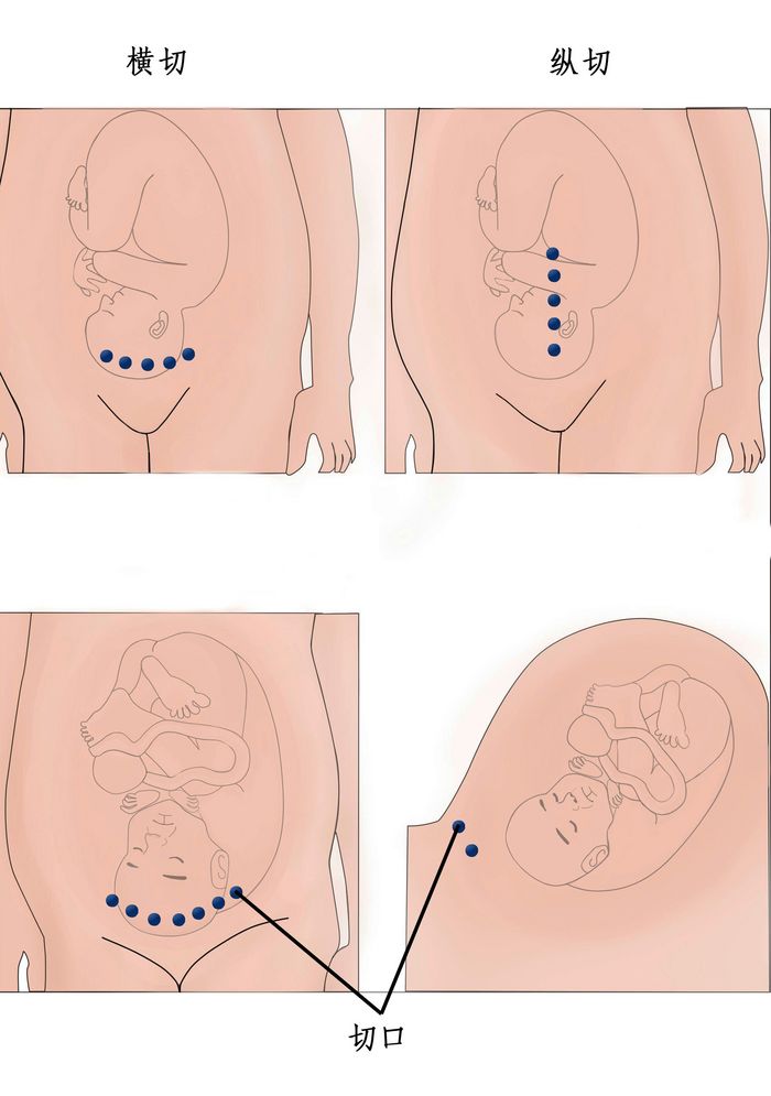 剖腹产分娩全过程图片