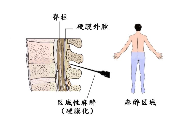 剖腹产分娩全过程图片