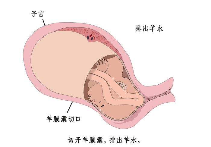 剖腹产分娩全过程图片