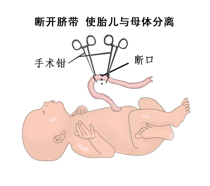 剖腹产分娩全过程图片