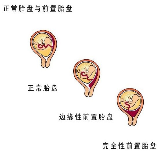 胎位不正的原因 纠正胎位不正的方法及时间