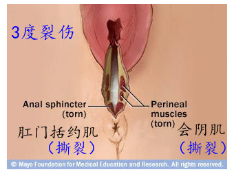 顺产分娩时刻 会阴撕裂损伤分级示意图