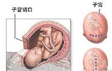 剖腹产后再次怀孕 孕妇不可不知道那些事！